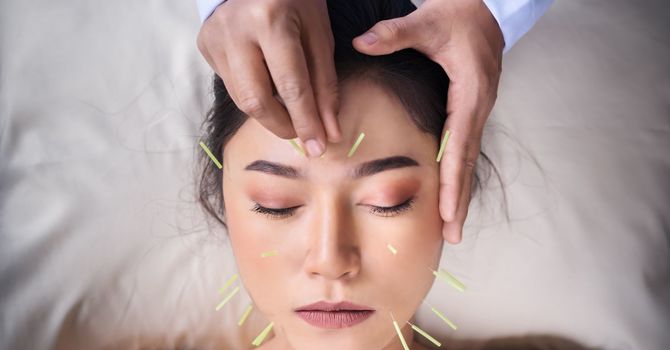 Acupuncture Treatment