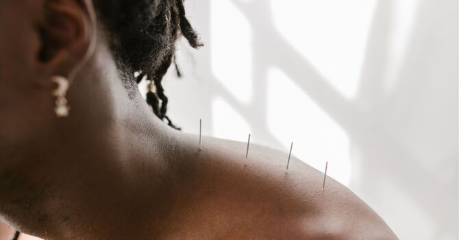 Acupuncture Treatment