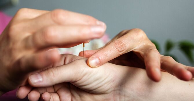 Acupuncture Treatment